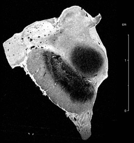 MRI scan of the substantia nigra of a Parkinson's patient. Scale on right measures 1.5 cm.