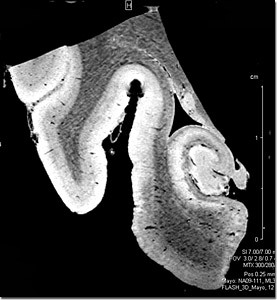 MRI scan of the hippocampus of an Alzheimer's patient. Scale on right measures 1.5 cm.